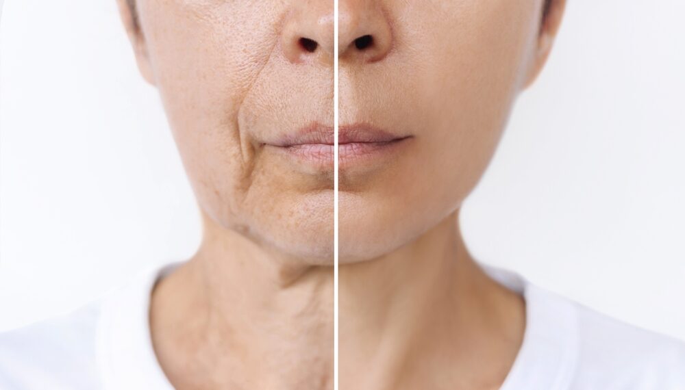 how to prevent wrinkles in your 30s naturally