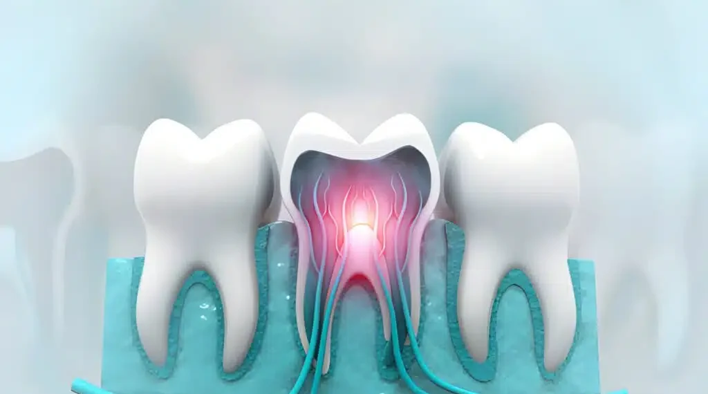 Kill Tooth Pain Nerve in 3 Seconds Permanently