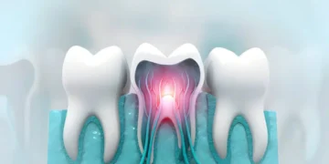Kill Tooth Pain Nerve in 3 Seconds Permanently