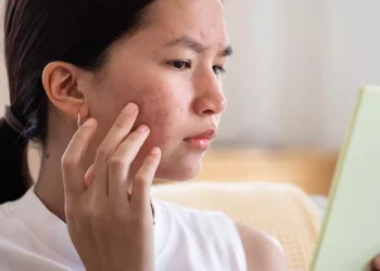 How to Treat Acne Naturally