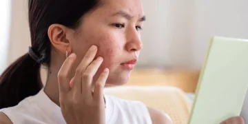 How to Treat Acne Naturally