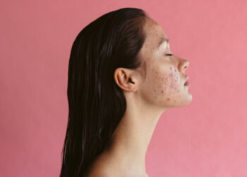 Natural remedies for hormonal acne in women over 30