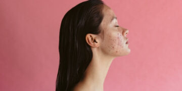 Natural remedies for hormonal acne in women over 30