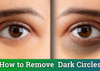how to reduce dark circles under eyes permanently