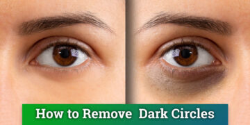 how to reduce dark circles under eyes permanently