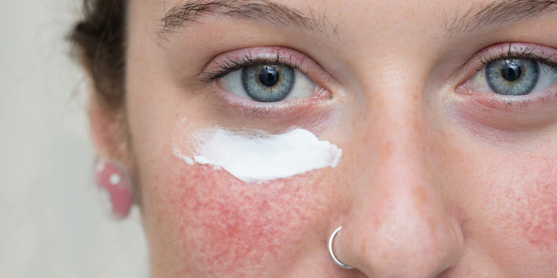 Anti-aging tips for women with rosacea