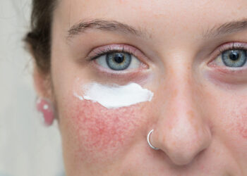 Anti-aging tips for women with rosacea