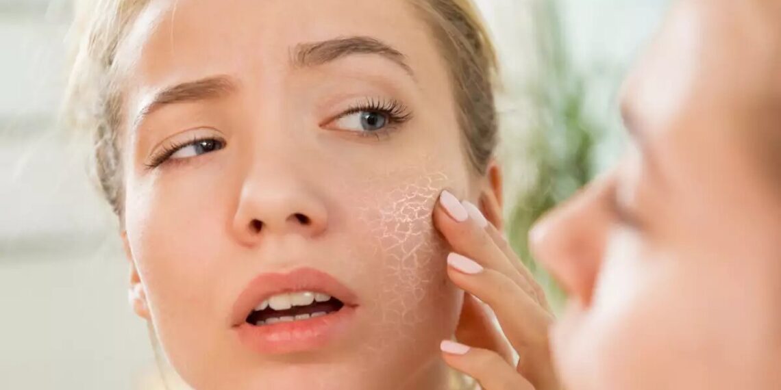natural remedies for dry flaky skin on face