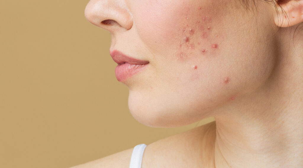 how to treat cystic acne at home naturally