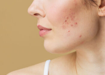 how to treat cystic acne at home naturally