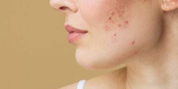 how to treat cystic acne at home naturally