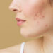 how to treat cystic acne at home naturally
