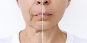 how to prevent wrinkles in your 30s naturally