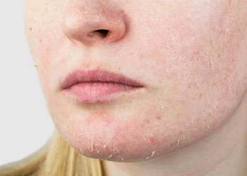 winter skincare tips for extremely dry skin