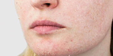 winter skincare tips for extremely dry skin