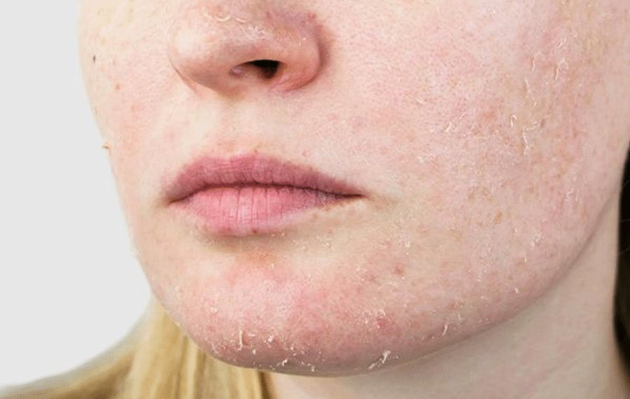 winter skincare tips for extremely dry skin