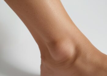 Understanding Cankles: Causes and Solutions