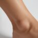 Understanding Cankles: Causes and Solutions
