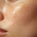 Common Causes of Oily Skin Explained